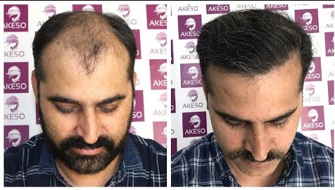 FUE hair transplant in Delhi - AKESO HAIR TRANSPLANT INDIA