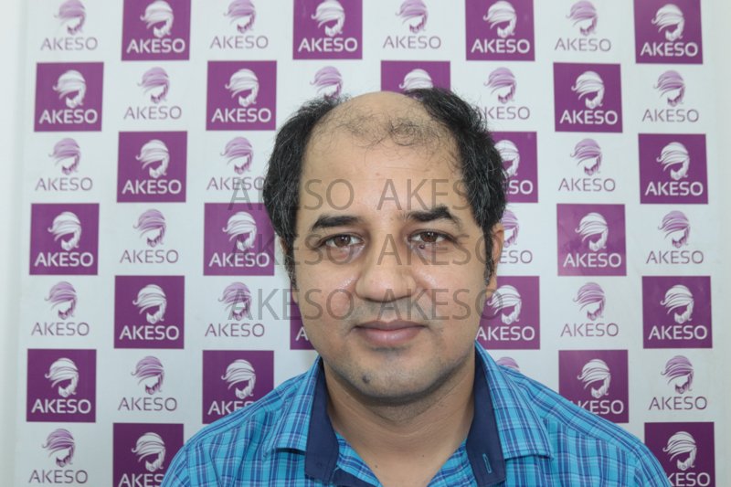 AKESO HAIR TRANSPLANT RESULTRANPB.jpg