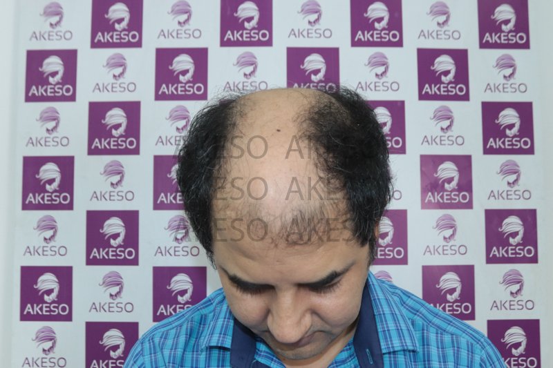 AKESO HAIR TRANSPLANT RESULTRANPC.jpg