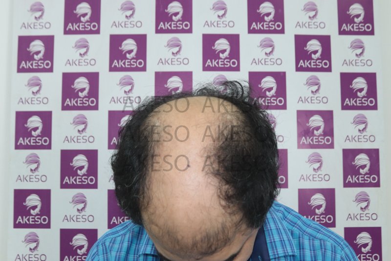 AKESO HAIR TRANSPLANT RESULTRANPF.jpg
