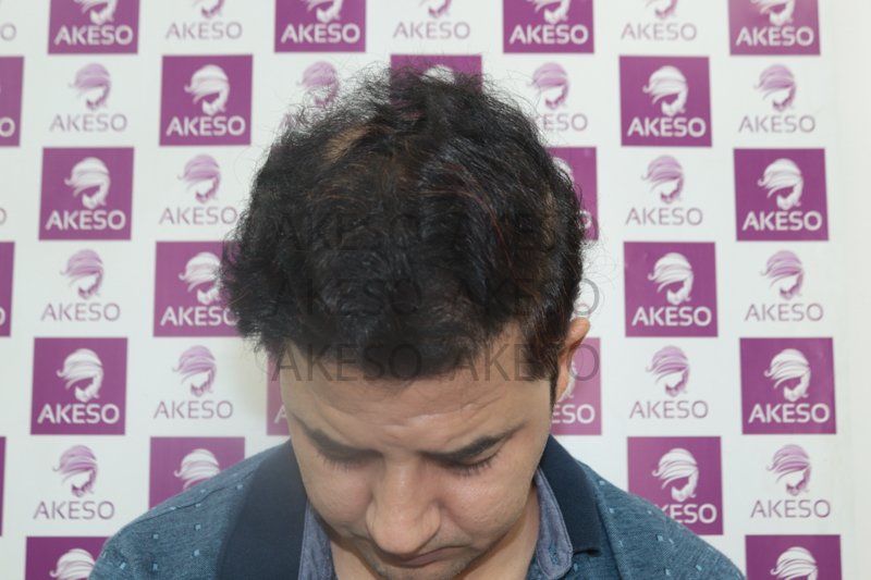 AKESO HAIR TRANSPLANT RESULTRANPK1.jpg