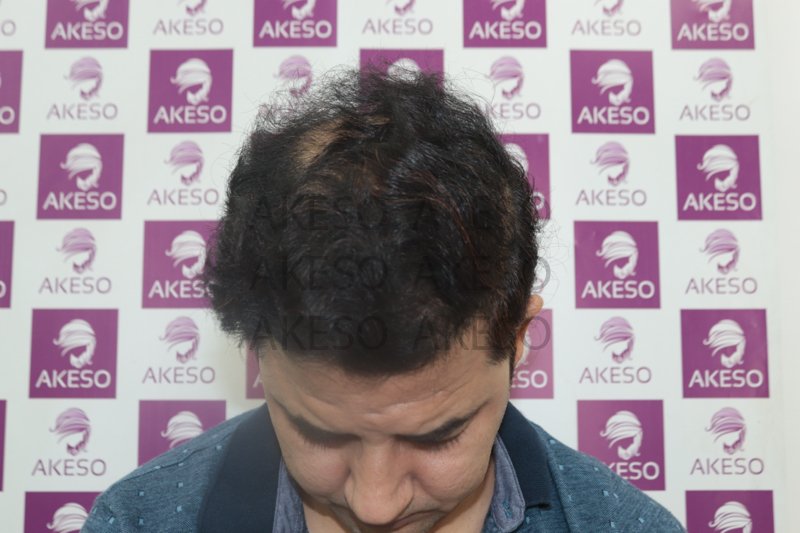 AKESO HAIR TRANSPLANT RESULTRANPL.jpg