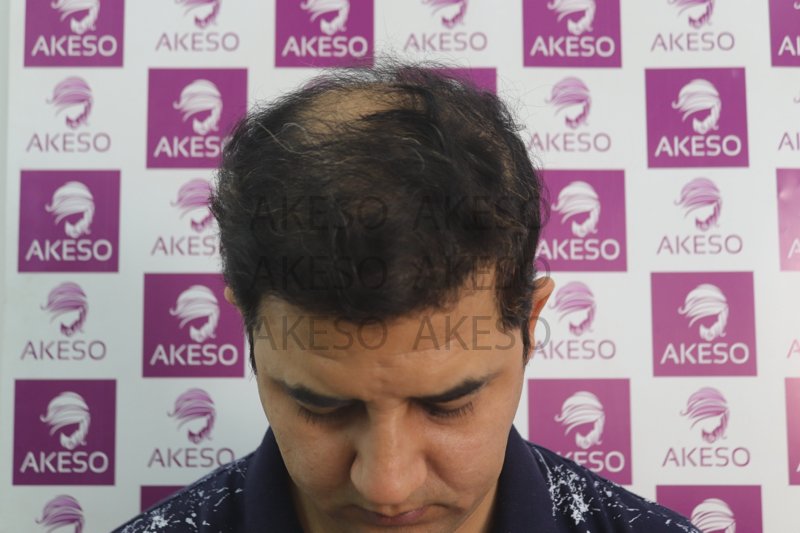 AKESO HAIR TRANSPLANT RESULTRANPL2.jpg