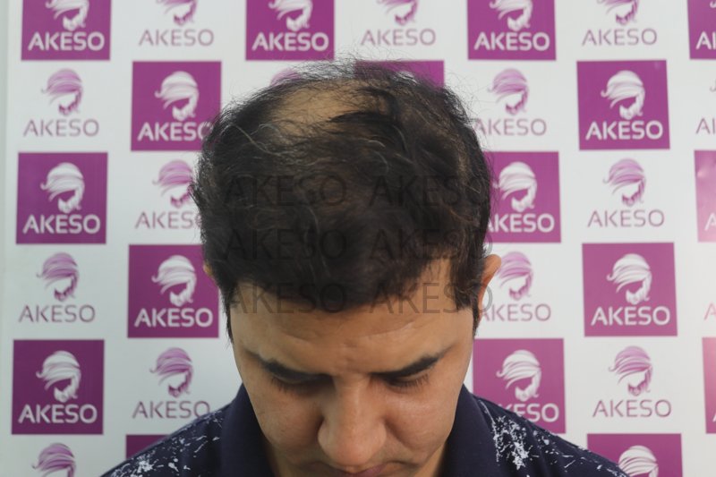 AKESO HAIR TRANSPLANT RESULTRANPL3.jpg