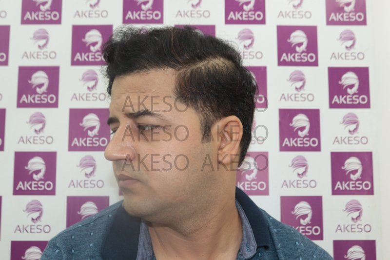 AKESO HAIR TRANSPLANT RESULTRANPU.jpg