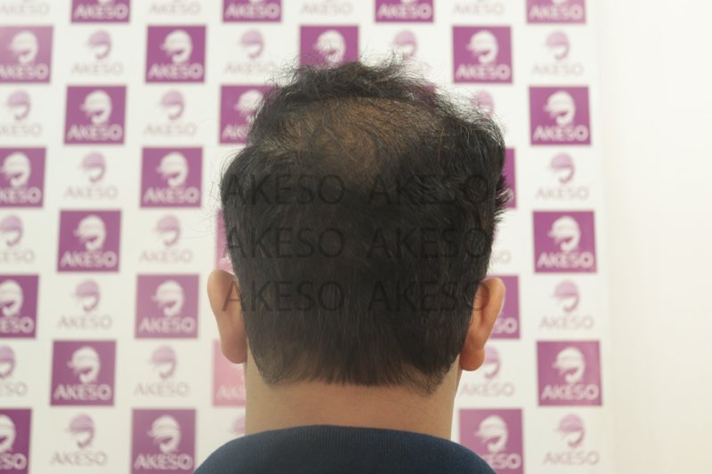 AKESO HAIR TRANSPLANT RESULTRANPU2.jpg