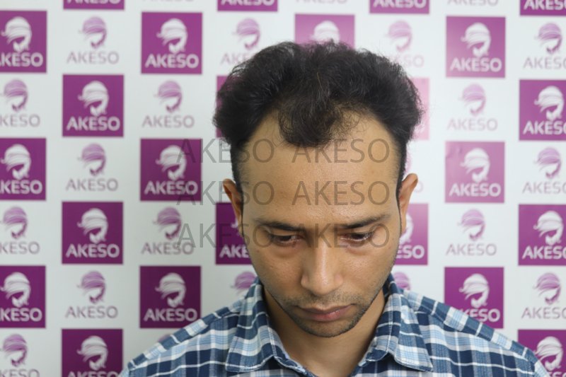 Spacer AKESO HAIR TRANSPLANT RESULTSANVHA4.jpg