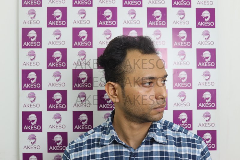 AKESO HAIR TRANSPLANT RESULTSANVHTB1.jpg