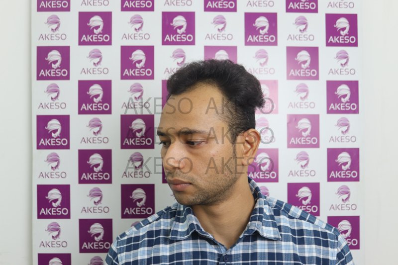 AKESO HAIR TRANSPLANT RESULTSANVHTB2.jpg