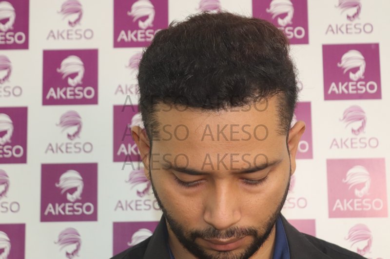 AKESO HAIR TRANSPLANT RESULTSANVHTC4.jpg