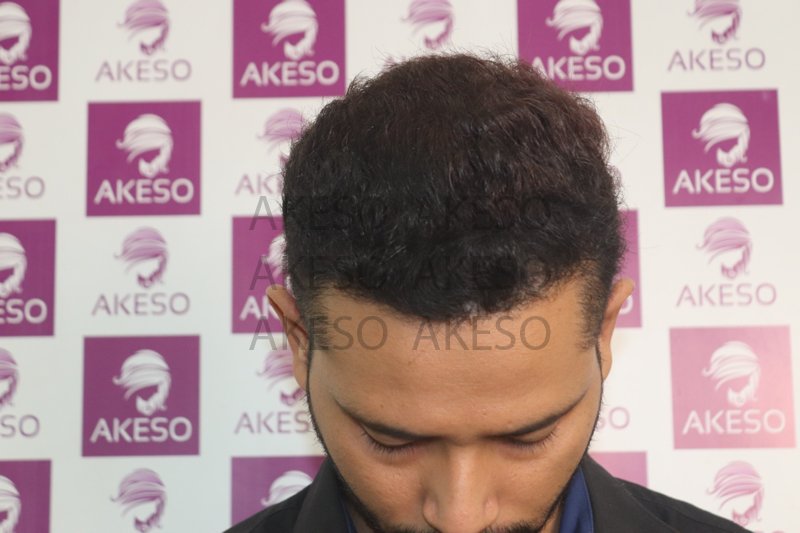 AKESO HAIR TRANSPLANT RESULTSANVHTC5.jpg