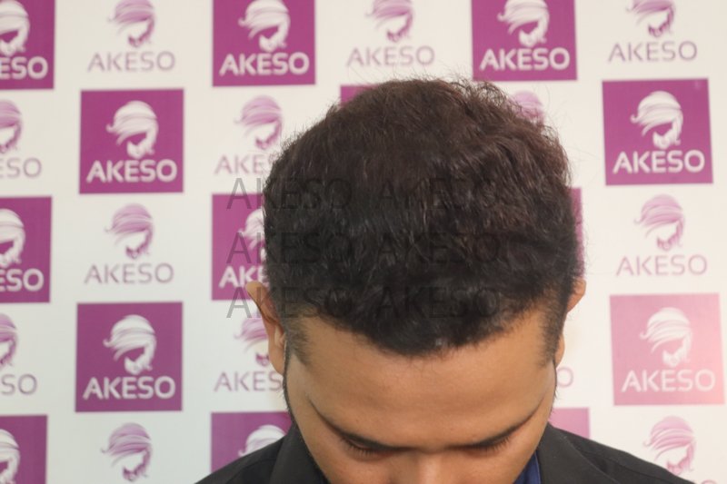AKESO HAIR TRANSPLANT RESULTSANVHTC6.jpg