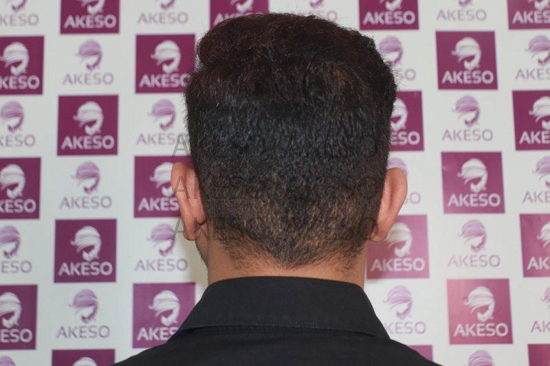 AKESO HAIR TRANSPLANT RESULTSANVHTZ.jpg
