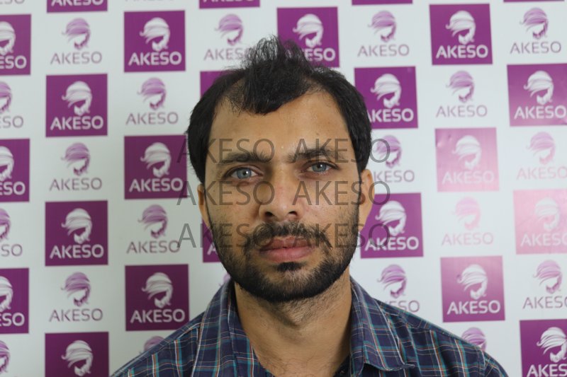 AKESO HAIR TRANSPLANT RESULT_GAUSA.jpg