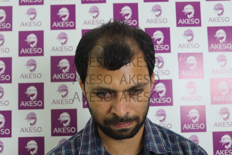 AKESO HAIR TRANSPLANT RESULT_GAUSB.jpg