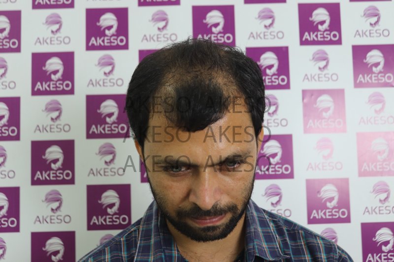 AKESO HAIR TRANSPLANT RESULT_GAUSD.jpg