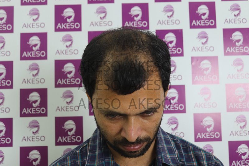AKESO HAIR TRANSPLANT RESULT_GAUSE.jpg