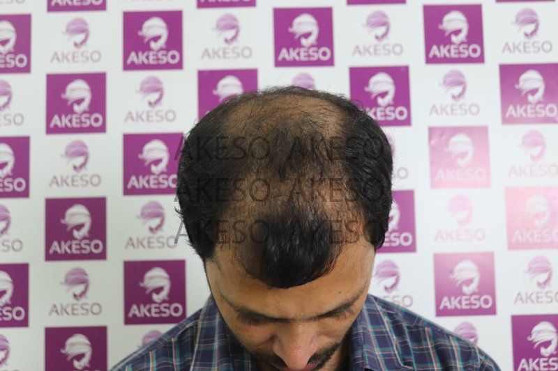 AKESO HAIR TRANSPLANT RESULT_GAUSF.jpg