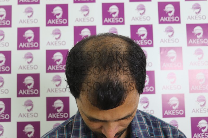 AKESO HAIR TRANSPLANT RESULT_GAUSG.jpg