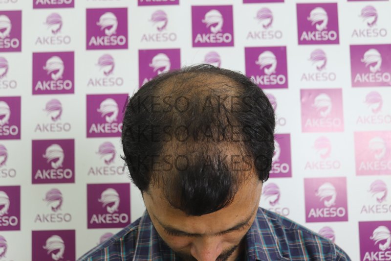 AKESO HAIR TRANSPLANT RESULT_GAUSH.jpg