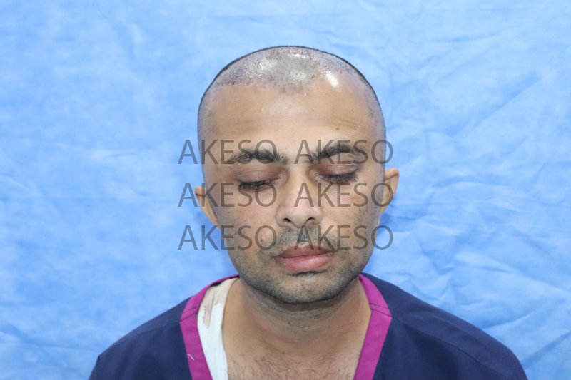AKESO HAIR TRANSPLANT RESULT_GAUSH1.jpg