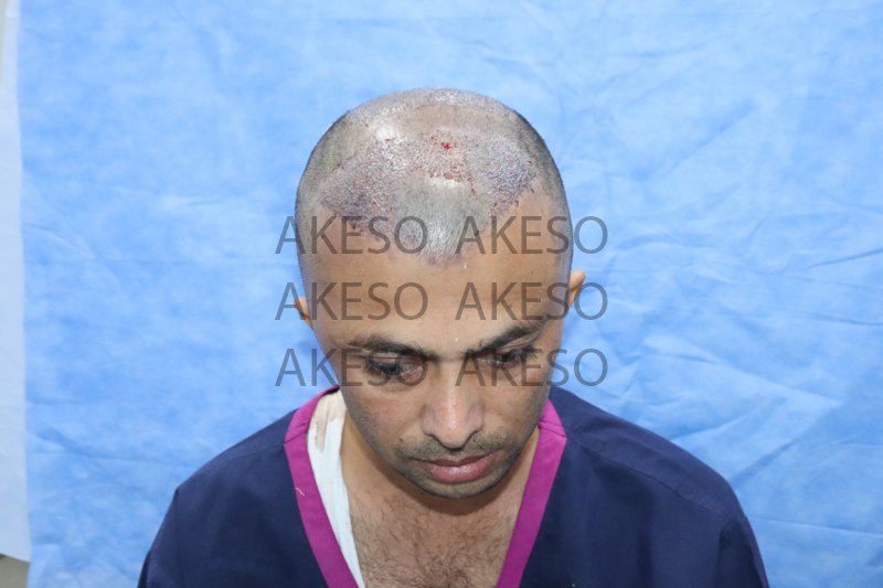 AKESO HAIR TRANSPLANT RESULT_GAUSH2.jpg