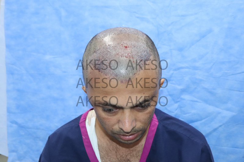 AKESO HAIR TRANSPLANT RESULT_GAUSH3.jpg