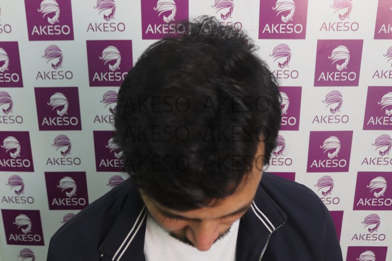 AKESO HAIR TRANSPLANT RESULT_GAUSM.jpg